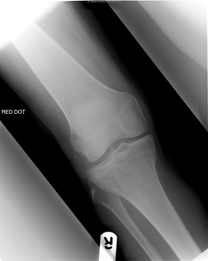 Anterior Tibial Plateau Fracture 6511